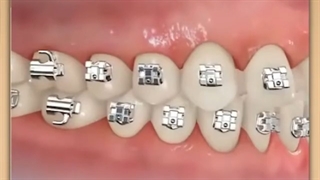 زنجیر پلاستیکی (پاور چین ارتودنسی) | دکتر فرهاد گرجی