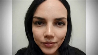 نمونه جراحی زیبایی بینی و چال گونه از دکتر اصحاب یمین