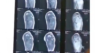 فیلم واقعی خارج سازی تومور سارکوم شانه