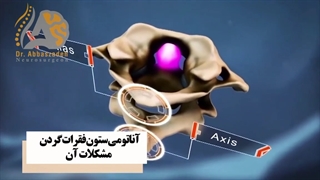 آناتومی ستون فقرات گردن و مشکلات آن
