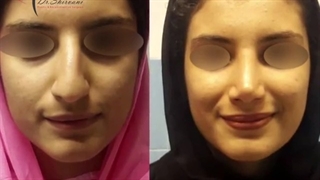 فیلم جراحی بینی بزرگ و قوزدار