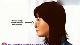 عمل بینی چگونه انجام می شود؟