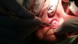 انجام عمل بلفاروپلاستی تحتانی توسط جراح ومتخصص چشم دکترسیدمحمدسالارظاهریانی