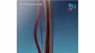 کمبود ویتامین D چه عوارضی دارد؟
