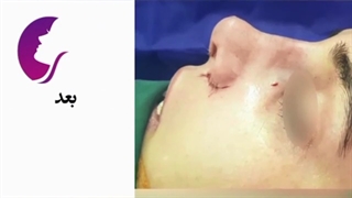جراحی زیبایی بینی از دکتر اسماعیل فرزاد فرد