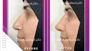 تزریق ژل به بینی جهت اصلاح فرم بینی
