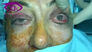 اصلاح رتراکسیون شدید پلک تحتانی بدلیل عمل نادرست