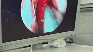 جراحی تومور بزرگ سینوس فکی با روش اندوسکوپی✅