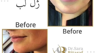 بعد از تزریق ژل لب