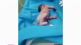 فیلم کامل زایمان سزارین بدون سانسور همراه با خارج کردن فیبروم رحم