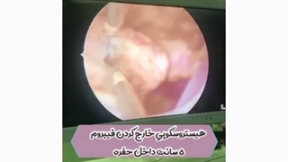 هیستروسکوپی خارج کردن فیبروم ۵سانت
