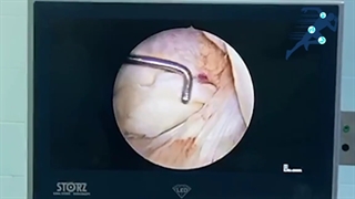فیلم جراحی ترمیم پارگی منیسک