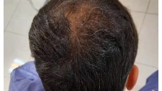 کاشت مو طبیعی