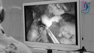 فیلم عمل اسلیو معده