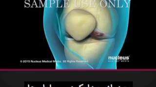 جراحی تعویض مفصل زانو (آرتروپلاستی)