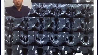 خارج سازی ضایعه کیستیک از فک بیمار