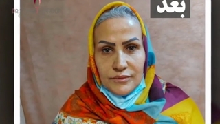 فیلم عمل بلفاروپلاستی پلک بالا