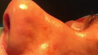 فیلم قبل و بعد عمل بینی