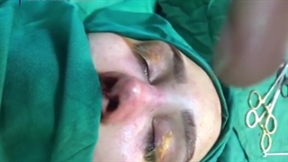 فیلم بعد از عمل زیبایی بینی