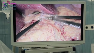 عمل کلاسیک بای پس معده