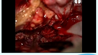 عمل جراحی مننژیوم شیار عصب بویایی