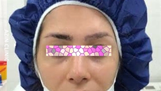 کاشت ابرو