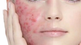 قوی ترین صابون ضد قارچ/۰۹۱۲۰۷۵۰۹۳۲/ قویترین صابون گوگرد