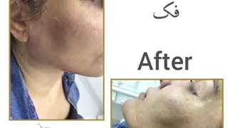 زاویه سازی فک