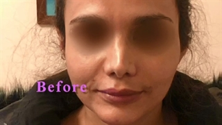 تخلیه ژل و تزریق چربی بعد از آن توسط دکتر ماریا مرادی