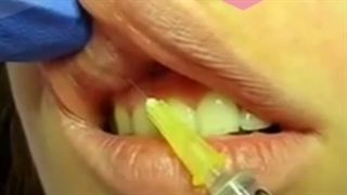 همه چیز در خصوص تزریق ژل به لب مزایا و معایب ماندگاری هزینه بلیچینگ دندان