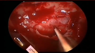 ️آدنوم هیپوفیز