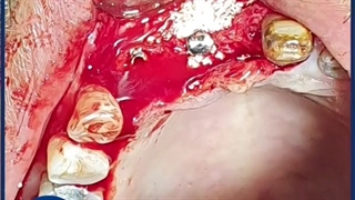 جراحی دو واحد ایمپلنت و بازسازی ناحیه با مواد پیوند استخوان