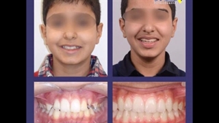 نمونه تصاویر قبل و بعد از درمان ارتودنسی توسط پروفسور عبدالرضا جمیلیان