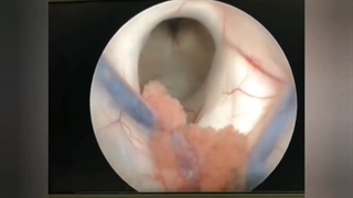 عمل جراحی آندوسکوپی بطن سوم
