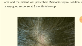 مزوتراپی مو .دکتر ابراهیم مقیمیwww.ebiderm.blogfa.com