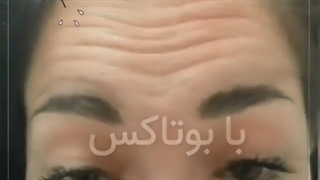 لیفت ابرو با بوتاکس