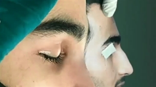 نمونه جراحی بینی توسط دکتر نصیبه رستمی