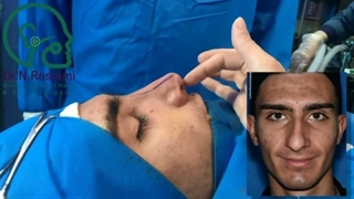 نمونه عمل بینی از دکتر نصیبه رستمی