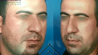 نمونه جراحی بینی مردانه از دکتر نصیبه رستمی