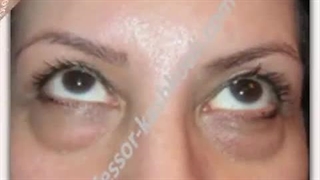 بلفاروپلاستی پلک تحتانی با پخش چربی | پروفسور کشکولی | جراح پلک تهران