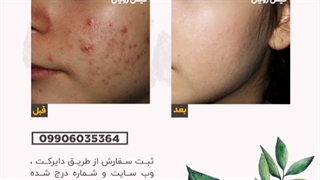 درمان خانگی جوش جای جوش صورت - جای لک اصلاح فرم صورت