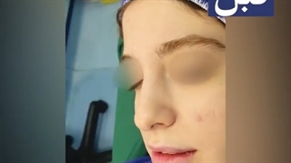 فیلم واقعی جراحی زیبایی بینی