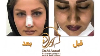 نمونه ای از عمل بینی