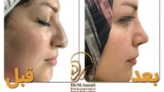 نمونه ای از رینوپلاستی