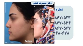 جراحی بینی متناسب با چهره فرد