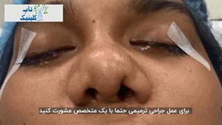 جراحی بینی ترمیمی