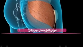 جراحی تعویض مفصل لگن یا آرتروپلاستی مفصل لگن