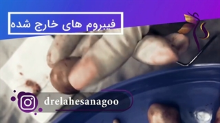 جراحی کیست تخمدان و فیبروم رحم