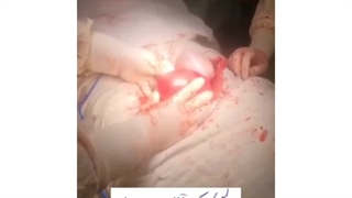 فیلم واقعی جراحی میومکتومی و سیستکتومی در خانم ۳۳ ساله