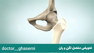 فیلم تعویض مفصل لگن و ران